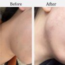 소담촌배곧신도시점(새롬프라자2차내 위치) | 예신관리 이중턱 관리는 '이뽐뷰티 배곧본점'으로 | 이중턱 관리 후기 | 턱살로 스트레스 받는 예비...