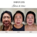 [천안 성거 피부관리]솔샵뷰티 크레이지 015 고주파로 탄력 피부관리!
