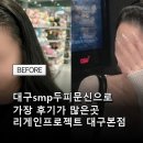 대구SMP | 대구smp두피문신으로 가장 후기가 많은곳 리게인프로젝트 대구본점 리얼후기사진과 방문 팁