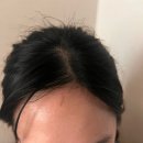 이루다성형외과의원 | 이마 찢어짐 꿰맴 - 창상봉합술