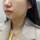 청담다이어트병원 얼굴지방분해주사 2회차 후기 윤곽주사 전후