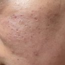 생기한의원 | 대구 여드름 치료 생기한의원 내돈내산 후기 2편