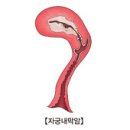 자궁내막암 (Endometrial Cancer) 이미지