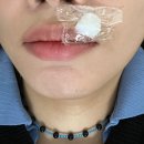 뿌리큰한의원 | 올해 숙원사업 한의원에서 점빼기 [피브로 한의원] | 점빼기 파침법 가격 시간 후기