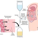 집에서 하는 투석 ' 복막투석' peritoneal dialysis 이미지