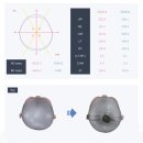수정-5 | 아기 두상 교정헬멧 5차 수정 방문 후기