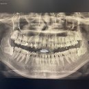 남주치과의원 | [전주 사랑니 치과] 김승룡 건치과 사랑니 발치 후기1