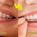강서구인비절라인 (Invisalign) 교정치과 착탈이 가능한 투명교정 장치 치아교정