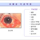 유행성 각결막염 이미지