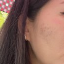 NO.1 자동차피부과 | 노원역 피부관리 도봉구피부과 한의원 새살침 1회차 후기