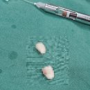 오에스티치과의원 | [톡톡사랑니치과] 사랑니 발치 후기 (상악 양쪽 사랑니)