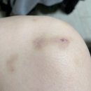 수민한의원 | 작열하는 태양이 나그네의 외투를 벗기는 방법(6월 정산)