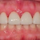 퍼플치과의원 | 검은색 잇몸 이유 변색치료 , 까만 잇몸미백 비용 통증