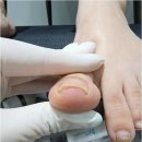 수성못역 | 대구 수성못역 주변 내성발톱 케어 어디서? 네일바이엘 전문 관리 안내