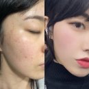 청담동 | BBL 비비엘 레이저 청담동피부과 후기 겨울철피부관리 로 새롭게