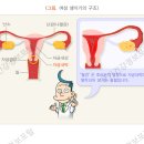 자궁내막증 이미지