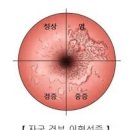 자궁경부이형성증 및 원인, (자궁이형성증, 원추절제술, 1단계, 2단계, 3단계) 이미지