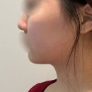 대안한의원 | 울써마지 vs 온토르, 압구정 한의원 얼굴윤곽 관리 전후 효과 후기