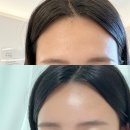 방외과의원 | 7년 만에 한 이마 필러+보톡스 찐 후기 일주일 변화 기록 천안‘이규형 성형외과의원‘