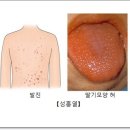 ● 칭다오 소아질병 발생 공지 : 성홍열(猩红热·Scarlet fever) 증가 이미지