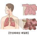 만성 폐쇄성 폐질환 정의 이미지