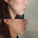 압구정찜질방사우나 | 압구정로데오역피부과 비대칭,이중턱 소프웨이브로 개선한 찐후기 (후기/통증/부작용/가격)