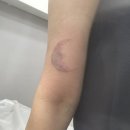 타투아쿠아 | 타투제거 9회 타투 지우기 내돈내산 후기 (2년 됐따)