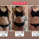 365MC의원 | [다이어트]365mc의원 무한람스 솔직 후기 (팔, 러브핸들) Q&amp;A 뭐든 물어보세요!🤭❤️