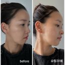 권피부과의원 | 수지구청역피부과 밴스의원 슈링크300샷 1회 리얼후기