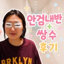 동탄퍼스트안과의원 | [화성 동탄] 샤일리안과 / 성인 안검내반 + 쌍수(절개) 리얼후기