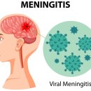 태선생 운동건강연구원(저스트바디짐) | [난곡PT] 단순 목 결림? 뇌수막염? 생명을 살리는 '3가지 임상 테스트' 꼭 확인하세요!