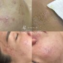 그린바이오메디칼(주) | 수라움에스떼 커스팀필링 프로그램 &#34;바이오리필&#34;