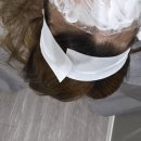 창피부과의원 | 청담동피부과 매쿰 시술 2주 후기 및 부작용