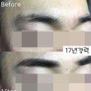 더블류성형외과 네이버블로그