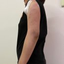 멍꿀잠 | 경산 팔 지방분해주사 당일 후기 붓기 멍 통증