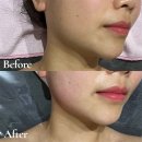 춘주로 | 춘천 윤곽관리 찐소개｜MZ에스테틱 윤곽관리 전후 후기 (예신 추천 피부샵)