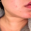 리본셀 AC GEL 후기｜모낭염·여드름 진정에 효과 있을까?
