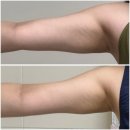 엄피부과의원 | 김포 피부과 평생 고민인 팔뚝 온다리프팅 받고 온 솔직후기