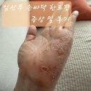 맑은마음병원 | 이대서울병원 산부인과 | 임산부 한포진 증상 및 후기