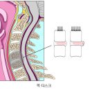 목디스크란? 이미지