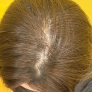 천안성성초등학교 | 솔직후기 천안 미용실 찰스리헤어테크 천안성성호수점 두피모발케어 시술 전후 클리닉 전문 비포 애프터...