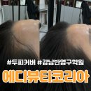 [에디뷰티코리아]양재 두피커버 헤어라인 문신 후기 / 자연스러운 헤어라인 M자 이마 탈모 정수리 커버...