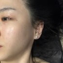 삼평동679-1 | 내돈내산 판교역 비립종제거 잡티제거