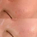 에셀 | 천안 모공관리 추천｜두정동 에셀로 아스피리포부스트 리프팅 후기