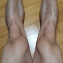 박용한의원 | 반원상 무릎 연골판 파열 수술 재활 후기 (feat. 파열부터 3년이 지난 현재까지)