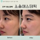 씨유진주평거우방점 | 진주 에스테틱, &#34;소솜에스테틱&#34; 기미 제거 후 솔직한 후기