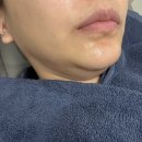 큐디 | 강남역 큐디의원 옥순리프팅 온다리프팅 효과