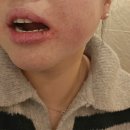 진영마미치과의원 | 발치의 신 사랑니 명의 선생님 존경합니다 서울이턱사랑니치과 내돈내산 발치후기 발치가격 매복사랑니