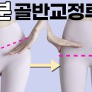 골반 교정[corrective pelvic osteotomy, acetabuloplasty]질환이란? 이미지