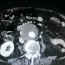 aortic dissection 이미지